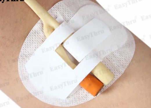 Fixation Medical Adhesive